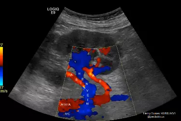 renal artery doppler, renal artery stenosis, colour doppler of kidneys, cost of colour doppler of the kidneys, best radiologist for colour doppler kidneys, best diagnostic centre in Bhiwadi